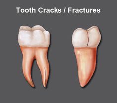 tooth cracks